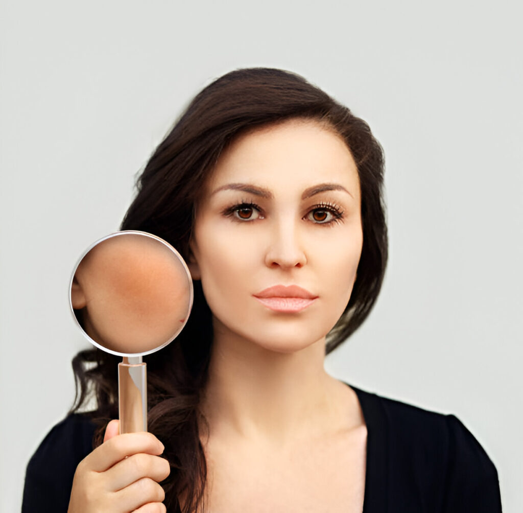 Chemical Peel For Hyperpigmentation