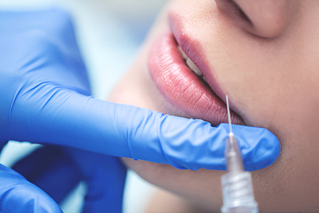 What Is A Lip Flip With Botox