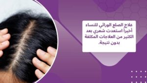 علاج الصلع الوراثي للنساء في الشارقة ودبي