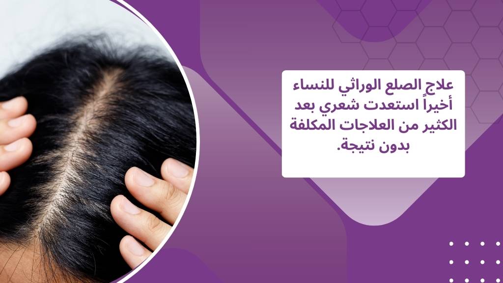 علاج الصلع الوراثي للنساء في الشارقة ودبي