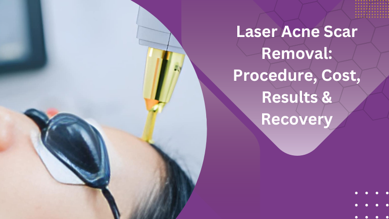 Laser Acne Scar Removal: Procedure, Cost, Results & Recovery