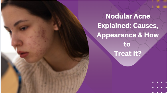 Nodular acne explained: Causes, appearance & how to treat it?