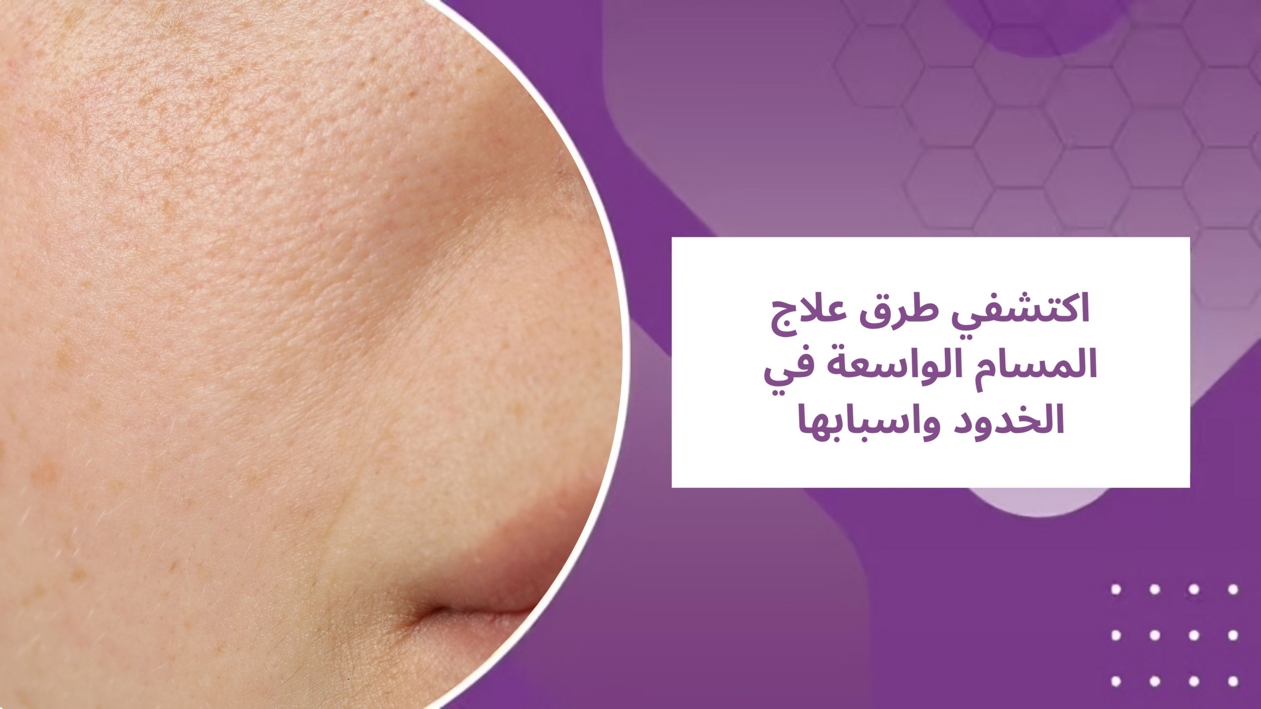 اكتشفي طرق علاج المسام الواسعة في الخدود واسبابها
