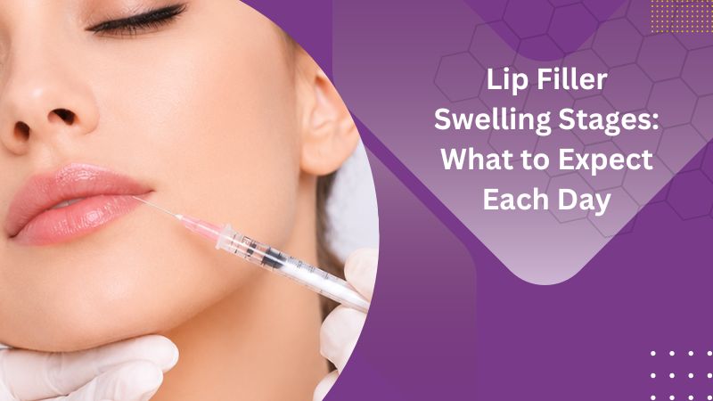 Lip Filler Swelling Stages