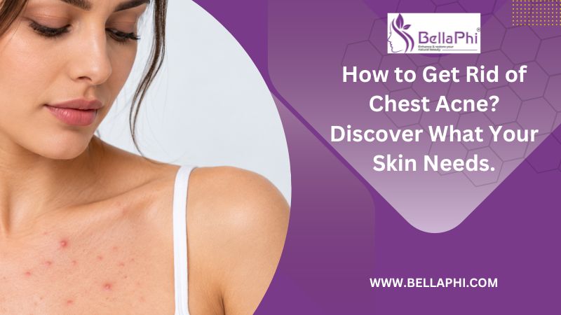 How to Get Rid of Chest Acne