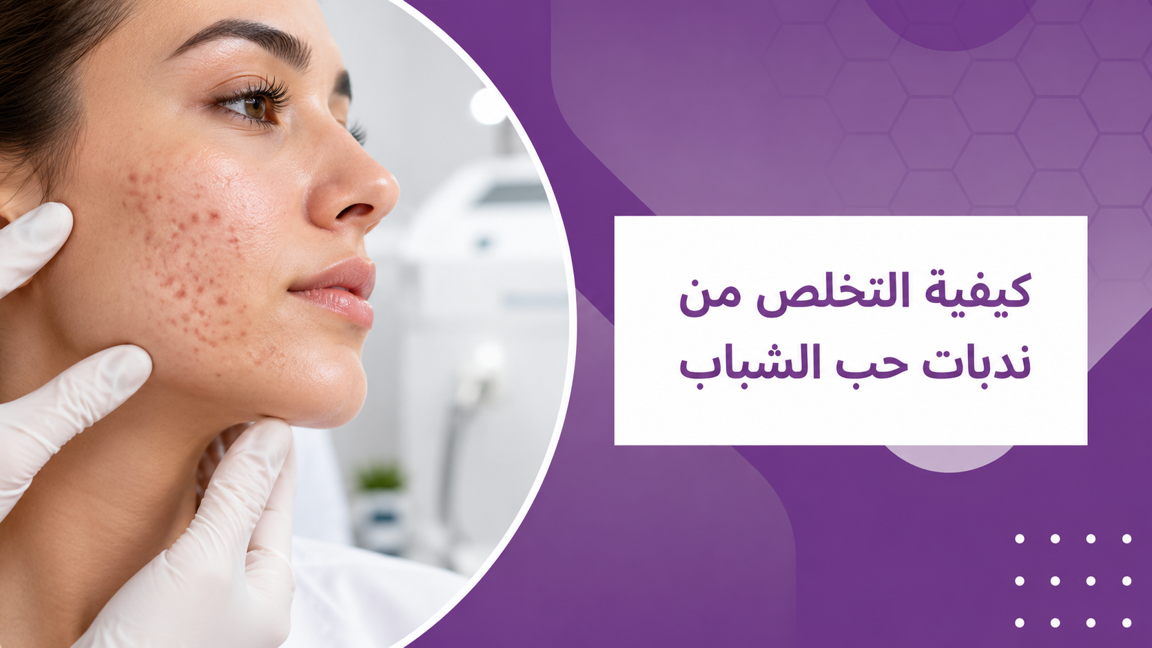 كيفية التخلص من ندبات حب الشباب